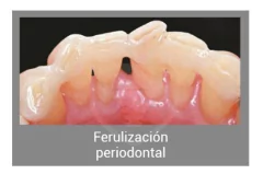 Interlig Fibra De Vidrio Trenzada Angelus - Dentalpack