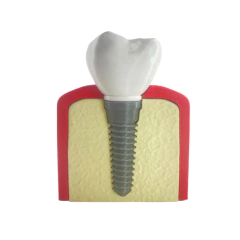 Maqueta Implante Dental