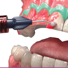 Blanqueamiento Opalescence Boost 40% + barrera gingival Ultradent - tienda online