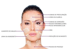 FIOS FILLER 21G x 38mm x 50mm / I-THREAD- 20 fios no pacote. - PRÓSPERE FACE MEDICAMENTOS