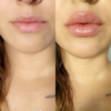 2 x 1 Labial voluminizador