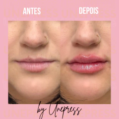 PREENCHEDOR RENNOVA FILL 1ML - comprar online