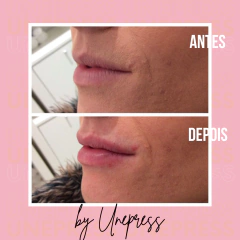 PREENCHEDOR RENNOVA FILL 1ML - loja online