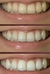 Tratamiento blanqueador de dientes en internet