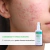 Cosmobeauty Acne Spec Tônico Adstringente Anti Acne 140ml - loja online