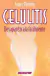 Celulitis