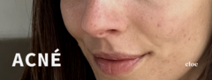 Banner de la categoría ACNÉ