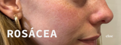 Banner de la categoría ROSÁCEA
