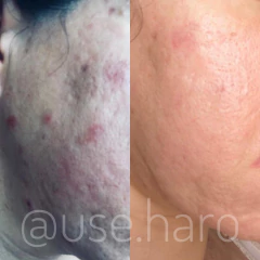 KIT ADEUS ACNE E OLEOSIDADE - loja online