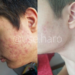 SABONETE DE BARBATIMÃO - ANTIACNE E REGENERADOR na internet