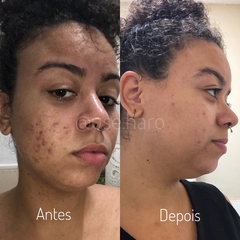 SABONETE DE BARBATIMÃO - ANTIACNE E REGENERADOR na internet