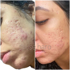 TRIO ANTIACNE - 3 SABONETES DE BARBATIMÃO - comprar online