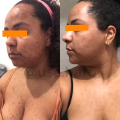 Imagem do BLEND CONTROL - SECATIVO DE ACNE E CICATRIZANTE