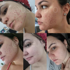 BLEND CONTROL - SECATIVO DE ACNE E CICATRIZANTE