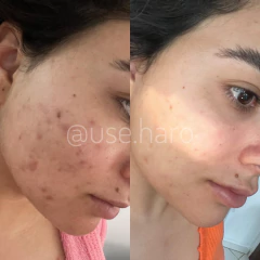 KIT ADEUS ACNE E OLEOSIDADE - USE HARO COSMÉTICOS