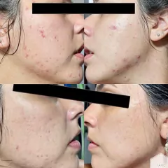 BLEND CONTROL - SECATIVO DE ACNE E CICATRIZANTE na internet
