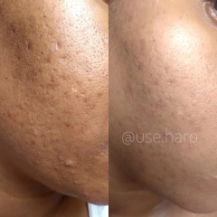 KIT ADEUS ACNE E OLEOSIDADE - USE HARO COSMÉTICOS