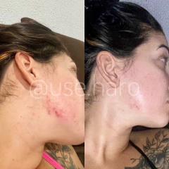 Imagem do KIT ADEUS ACNE E OLEOSIDADE