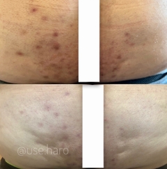 SABONETE DE BARBATIMÃO - ANTIACNE E REGENERADOR - USE HARO COSMÉTICOS