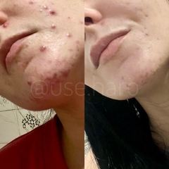 KIT ADEUS ACNE E OLEOSIDADE na internet