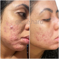 TRIO ANTIACNE - 3 SABONETES DE BARBATIMÃO