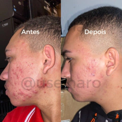 TRIO ANTIACNE - 3 SABONETES DE BARBATIMÃO - USE HARO COSMÉTICOS