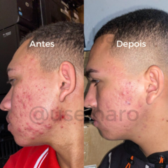 KIT ADEUS ACNE E OLEOSIDADE - comprar online