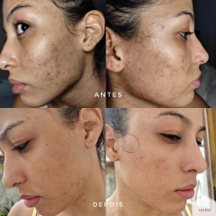 TRIO ANTIACNE - 3 SABONETES DE BARBATIMÃO - USE HARO COSMÉTICOS