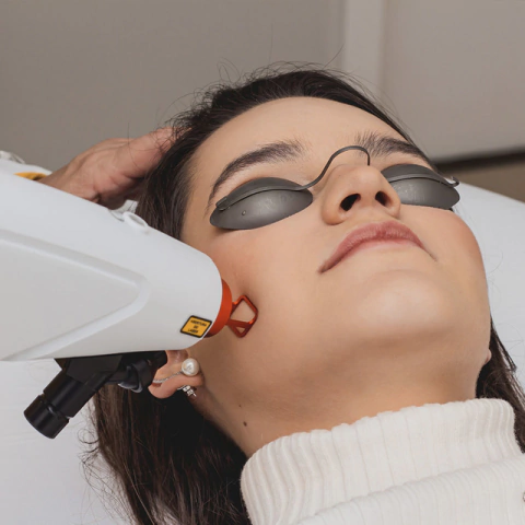 3 sessões de Laser de Rejuvenescimento Facial, Pescoço e Colo