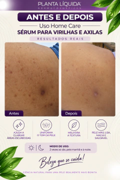 Kit Para Clareamento De Manchas Em Virilhas E Axilas