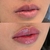Revitalização Labial com Microagulhamento