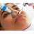 Revitalização Labial com Microagulhamento