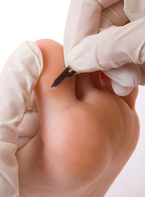 Pedicuría con Bisturí sin esmaltado - comprar online