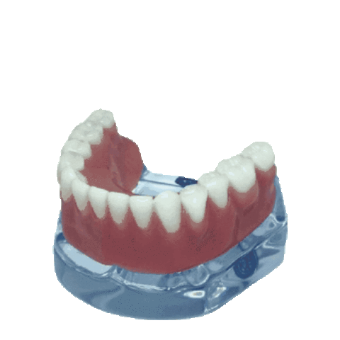 Macro Modelo Anatômico Odontológico Mandíbula Overdenture Acrílica com 2 O'Rings e Prótese Inferior
