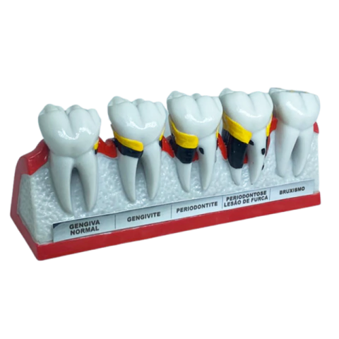 Macro Modelo Anatômico Odontológico Evolução da Doença Periodontal com Furca e Bruxismo