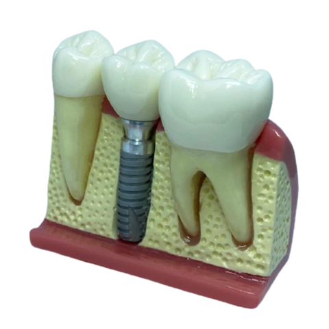 Macro Modelo Anatômico Odontológico com Ponte Fixa 3 Elementos e Macro Implante