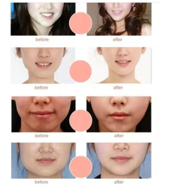 Mascarilla Lifting Facial En Forma De V Vendaje Adelgazante - tienda online