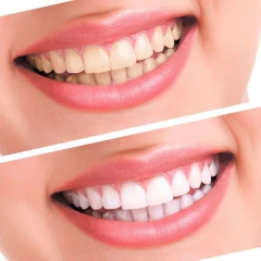 Blanqueador Dental Con Luz Led Blanqueamiento De Dientes en internet