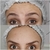 TOXINA BOTULÍNICA - BOTOX