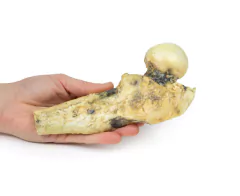 Modelo 3D de Osteossarcoma do fêmur - comprar online