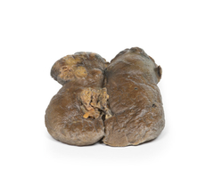 Modelo 3D de Carcinoma de células renais na internet