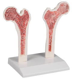Modelo Anatômico de Fêmur com osteoporose