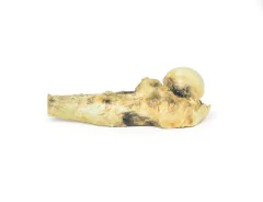 Modelo 3D de Osteossarcoma do fêmur