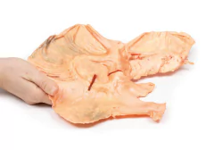 Modelo 3D de Adenocarcinoma do estômago - comprar online