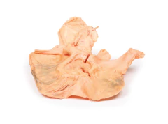 Modelo 3D de Adenocarcinoma do estômago