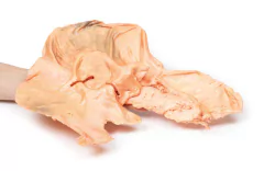 Modelo 3D de Adenocarcinoma do estômago - Medical-X | Simuladores Para Treinamento Médico