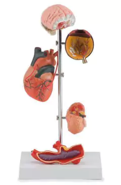 Modelo Anatômico de Efeitos da Hipertensão