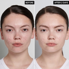 *PREORDEN* The INKEY Succinic Acid Acne Treatment en internet