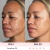 Comparação de resultados do Lift Facial com HIFU mostrando o antes e depois em 30 dias no rosto de uma mulher, evidenciando melhora na textura e uniformidade da pele.