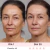 Antes e depois do tratamento facial com HIFU mostrando rejuvenescimento do rosto de uma mulher de 46 anos após 30 dias, com redução de rugas e pele mais firme.